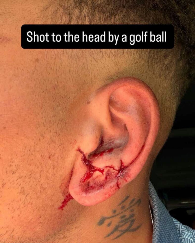 Kane Brown hit in head by golf ball
