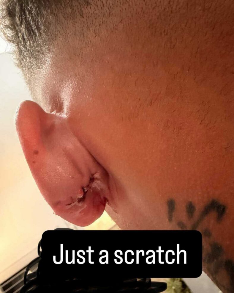 Kane Brown hit in head by golf ball